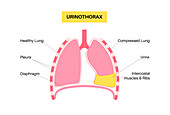 Urinothorax, illustration