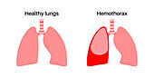 Haemothorax, illustration