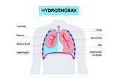 Hydrothorax, illustration