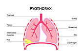 Pyothorax, illustration