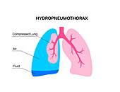 Hydropneumothorax, illustration