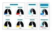 Pleural effusion, illustration