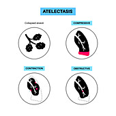 Atelectasis, illustration
