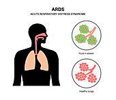 Acute respiratory distress, illustration