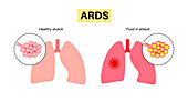 Acute respiratory distress, illustration