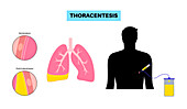Thoracentesis medical procedure, illustration