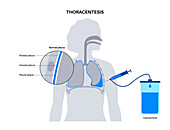 Thoracentesis medical procedure, illustration