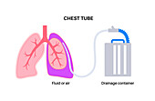 Chest tube catheter, illustration