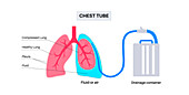 Chest tube catheter, illustration