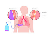 Tunnelled pleural catheter, illustration
