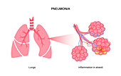 Pneumonia infection, conceptual illustration