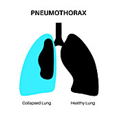 Pneumothorax, illustration