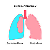 Pneumothorax, illustration