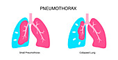 Pneumothorax, illustration