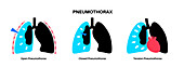 Pneumothorax, illustration