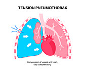 Tension pneumothorax, illustration