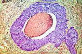 Cervical cancer, LM