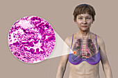 Woman with lung cancer, illustration