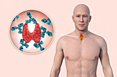 Autoimmune thyroiditis, illustration