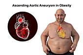 Obese man with ascending aortic aneurysm, illustration