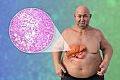 Overweight man with liver steatosis, illustration