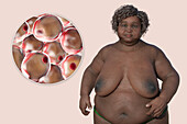 Overweight woman and adipocytes, illustration