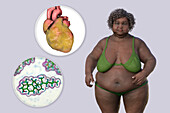 Overweight woman with enlarged heart, illustration