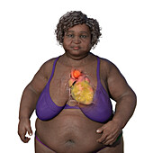 Obese woman with ascending aortic aneurysm, illustration