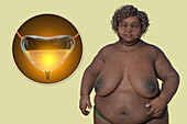 Senior overweight woman and urinary bladder, illustration