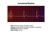 Junctional rhythm of the heartbeat, illustration