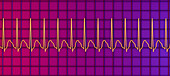 Supraventricular tachycardia heartbeat rhythm, illustration