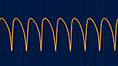 Ventricular tachycardia heartbeat rhythm, illustration