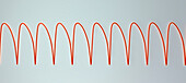 Ventricular tachycardia heartbeat rhythm, illustration