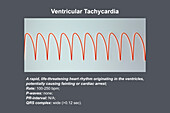 Ventricular tachycardia heartbeat rhythm, illustration