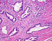 Adenocarcinoma of the colon, light micrograph