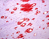 Cerebral microhaemorrhages, light micrograph