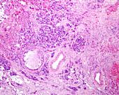 Adrenal cortex carcinoma, light micrograph