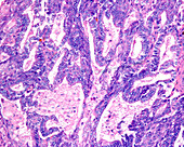Ovarian epithelial cancer, light micrograph
