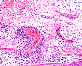 Inflammation in leukocyte diapedesis, light micrograph