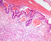 Gangrenous cholecystitis, light micrograph