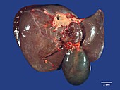 Hydrops of gallbladder