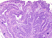 Gallbladder cancer, light micrograph