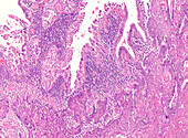 Gallbladder cancer, light micrograph