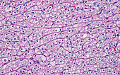 Chromophobe kidney cancer cells, light micrograph