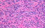 Leiomyoma, light micrograph