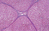 Liver cirrhosis, light micrograph