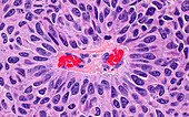 Papillary urothelial cancer, light micrograph