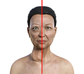 Woman with Graves' disease, illustration