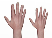 Hand with acromegaly compared to healthy hand, illustration