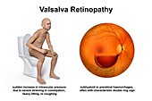 Valsava retinopathy, illustration